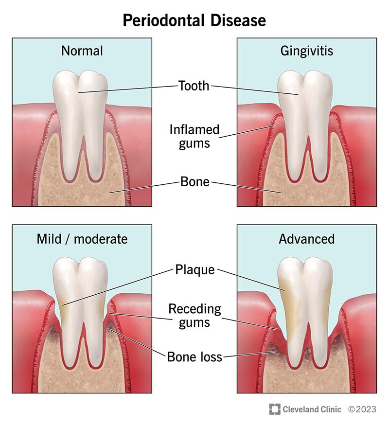 Gum Recession