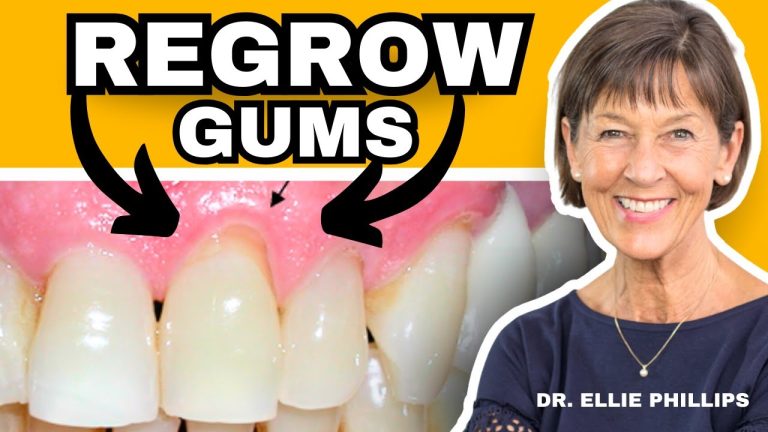 Receding Gums