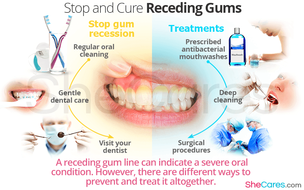 Can you fix receding gums by brushing?